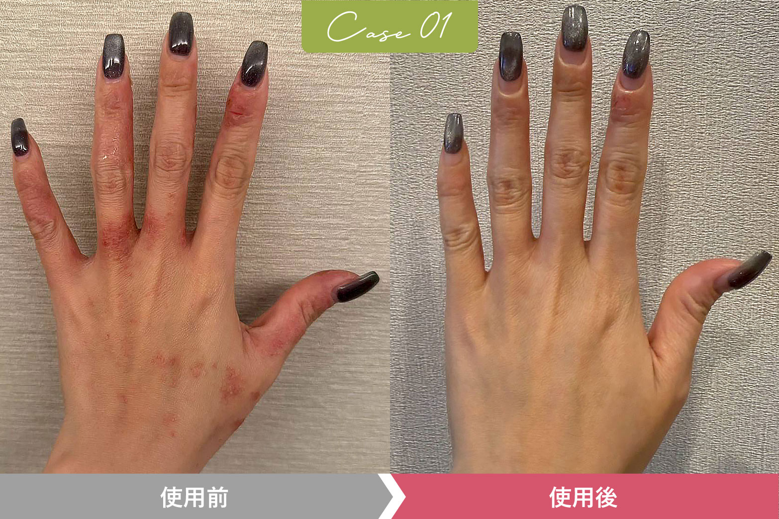 VIEAQ HND CAREGEL（ヴィアク　ハンドケアジェル）を使用した改善画像01