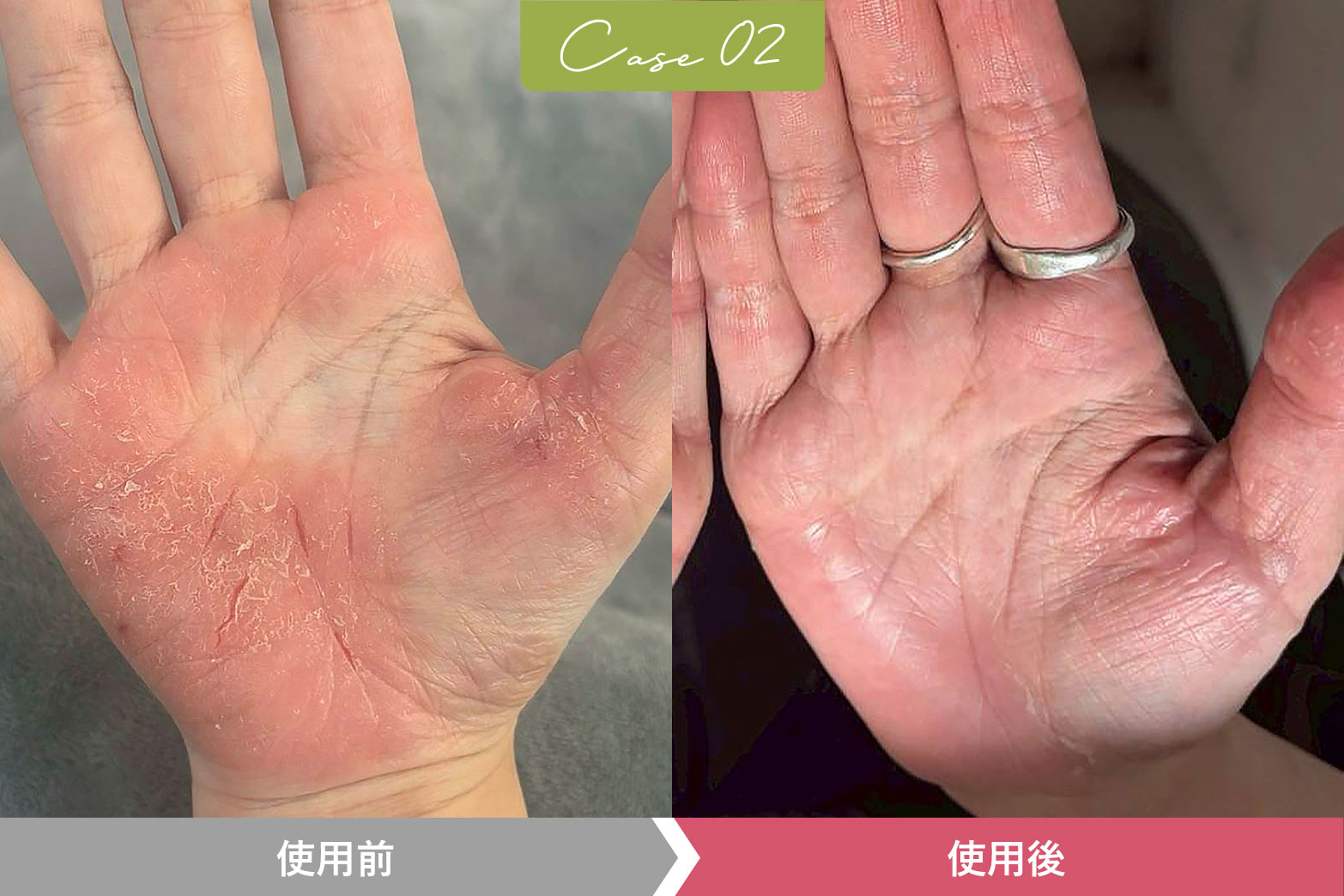 VIEAQ HND CAREGEL（ヴィアク　ハンドケアジェル）を使用した改善画像02